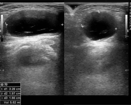 Hydrocele | Radiology Reference Article | Radiopaedia.org