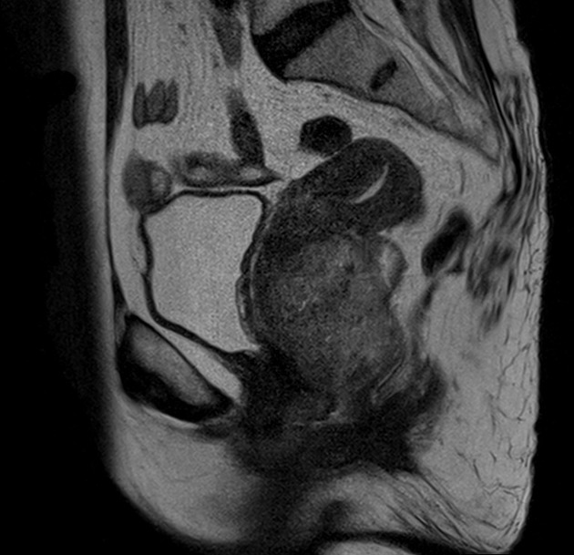 Cervical Carcinoma Radiology Reference Article 8538