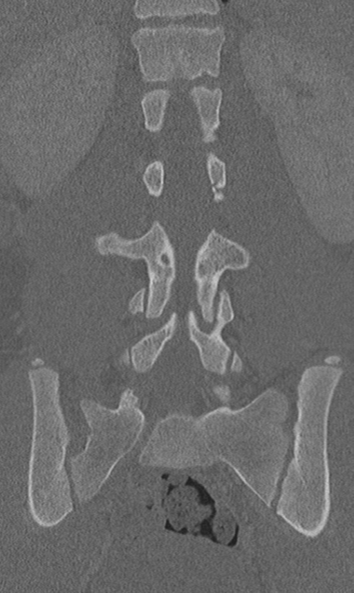 Chance fracture | Image | Radiopaedia.org