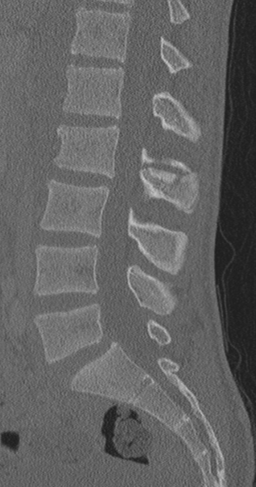 Chance fracture | Image | Radiopaedia.org