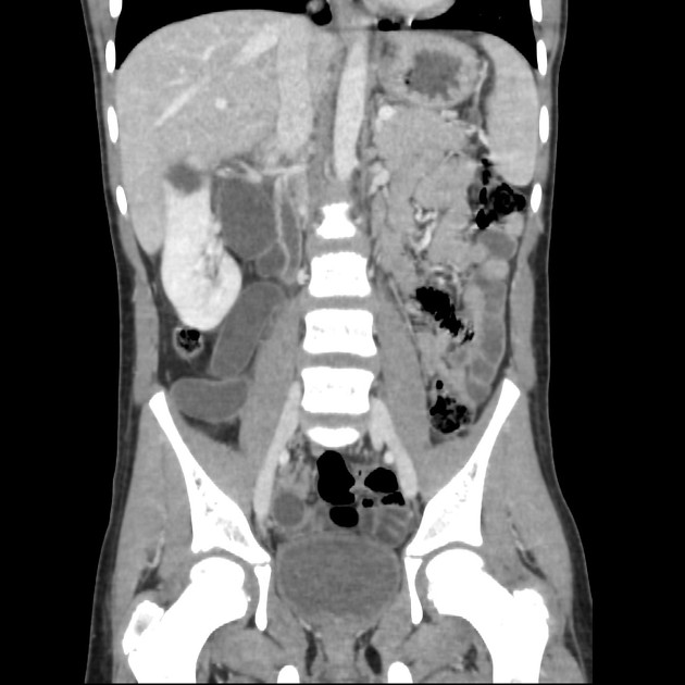 Duplex Kidney With Ectopic Ureter Radiology Case Radiopaedia Org