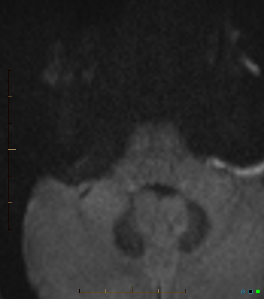 Arachnoid cyst - cerebellopontine angle | Image | Radiopaedia.org