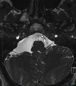 Arachnoid cyst | Radiology Reference Article | Radiopaedia.org