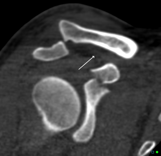 Avulsion fracture coracoid process | Image | Radiopaedia.org