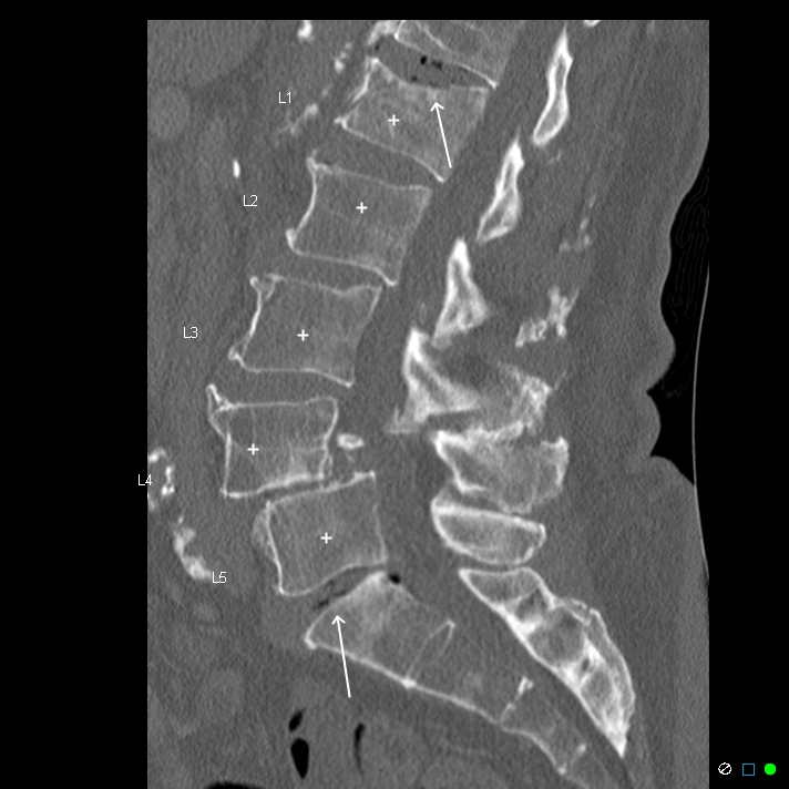 Transient lumbar disc vacuum phenomenon | Image | Radiopaedia.org