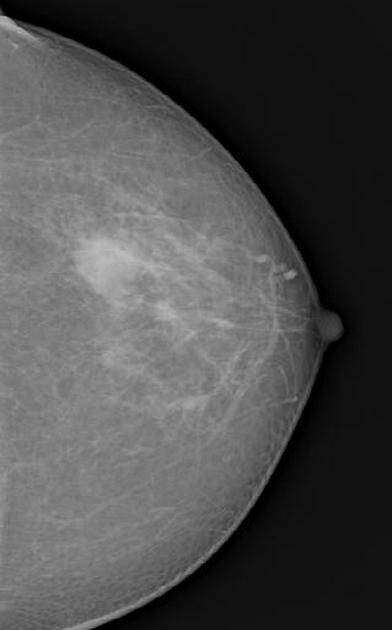 Simple breast cyst Radiology Reference Article Radiopaedia