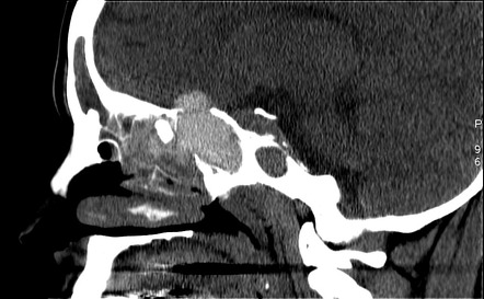 Fungal sinusitis - mucormycosis | Radiology Case | Radiopaedia.org