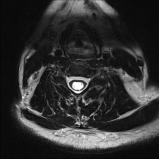 Chiari I Malformation Image 8414