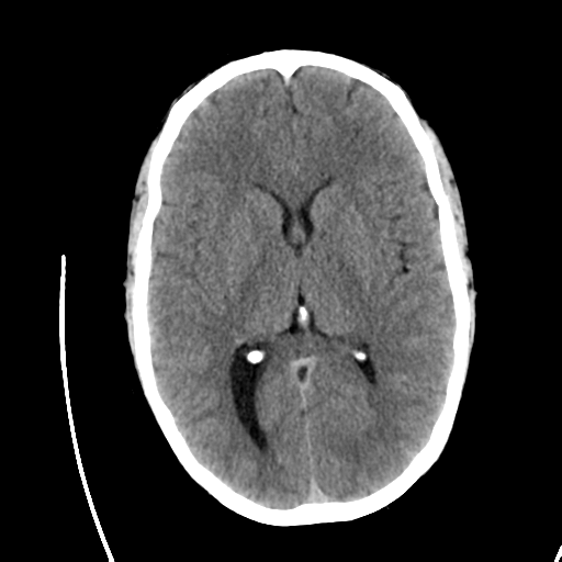 Chiari I malformation | Image | Radiopaedia.org