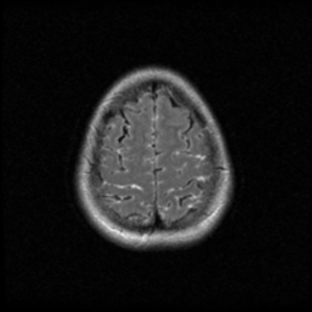 Aseptic meningitis | Radiology Case | Radiopaedia.org