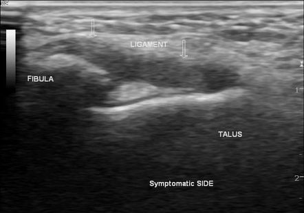 Anterior talofibular ligament injury | Radiology Case | Radiopaedia.org