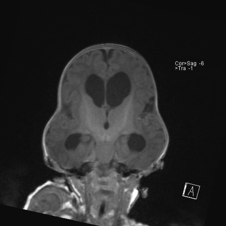 Pfeiffer syndrome | Radiology Reference Article | Radiopaedia.org