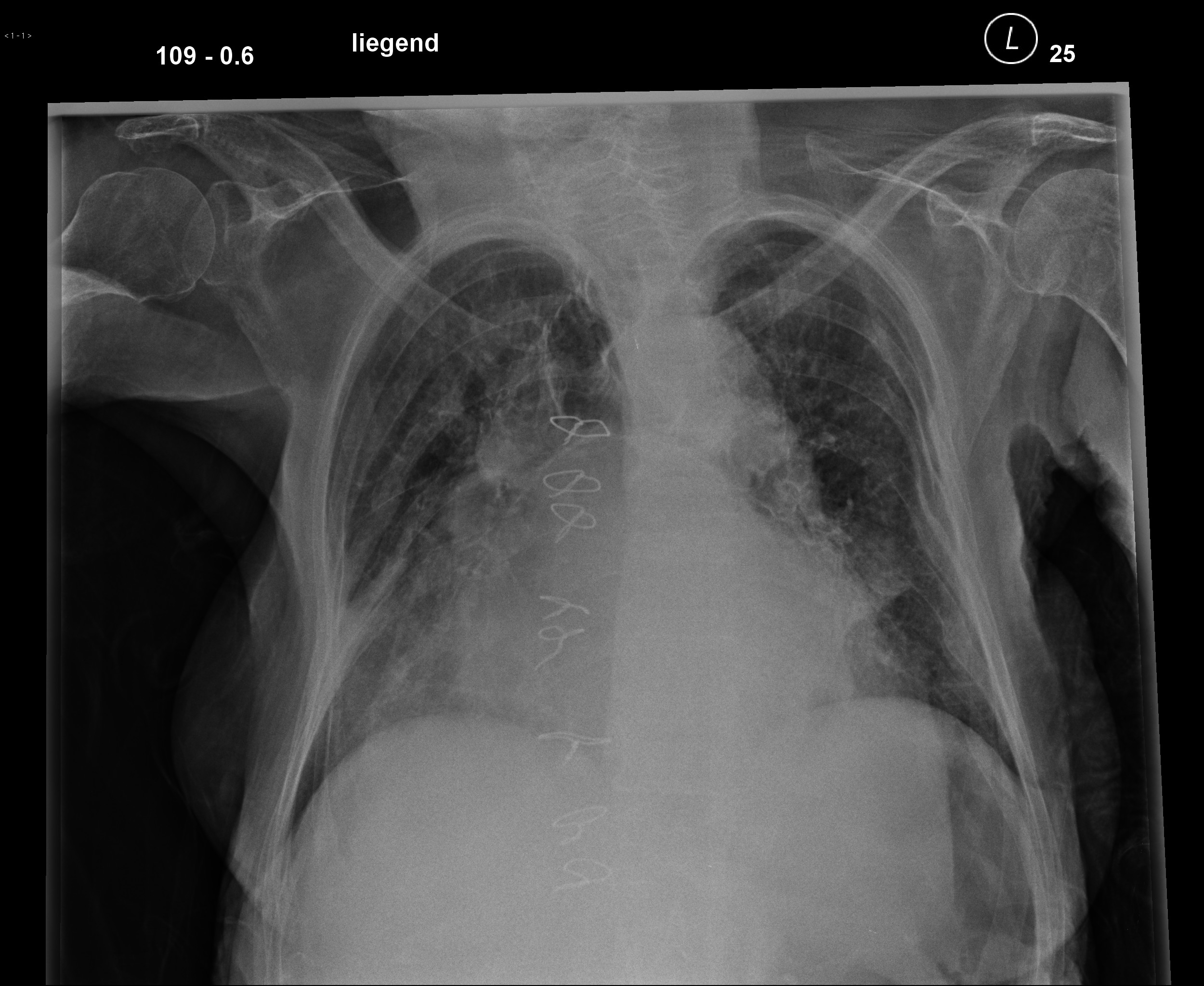 Effects Of Left Atrial Enlargement