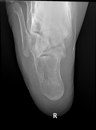 Calcaneal intraosseous lipoma | Radiology Case | Radiopaedia.org