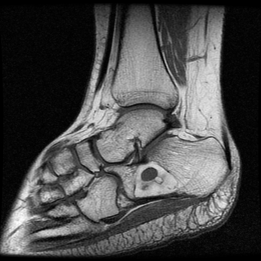 Calcaneal intraosseous lipoma | Image | Radiopaedia.org