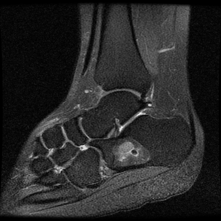 Calcaneal intraosseous lipoma | Image | Radiopaedia.org