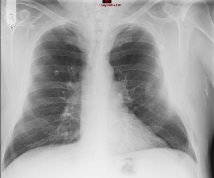 Intercostal lung herniation | Radiology Case | Radiopaedia.org