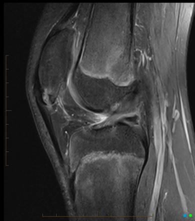 Patellar Sleeve Fracture Radiology Reference Article Radiopaedia Org