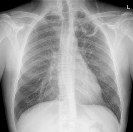 Pulmonary tuberculosis | Radiology Case | Radiopaedia.org