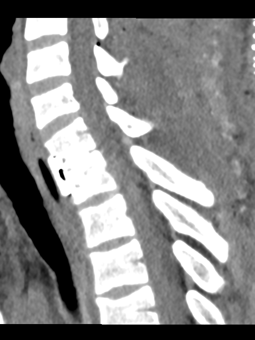 Unilateral perched facet fracture dislocation | Image | Radiopaedia.org