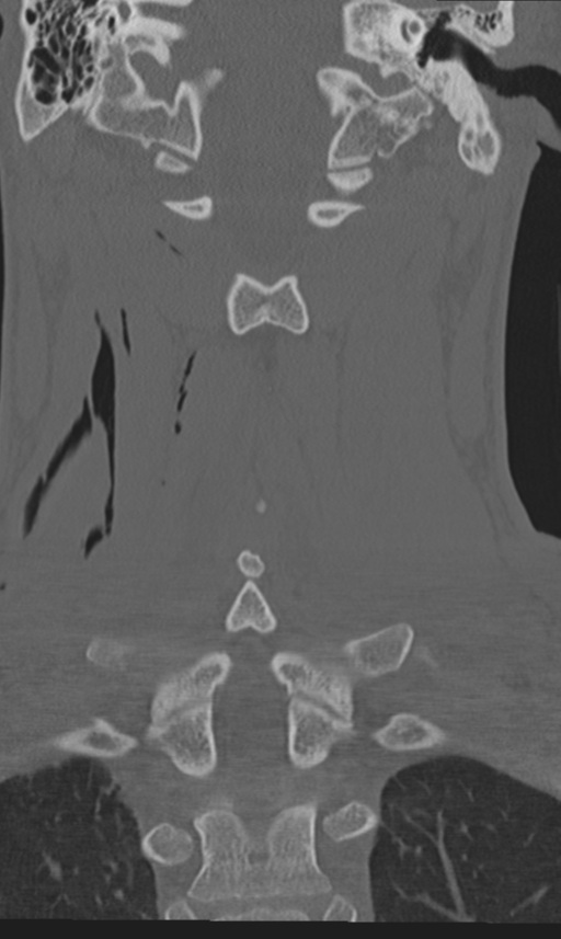 Unilateral Perched Facet Fracture Dislocation Image