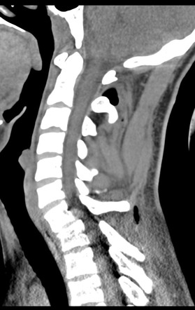 Unilateral perched facet fracture dislocation | Image | Radiopaedia.org