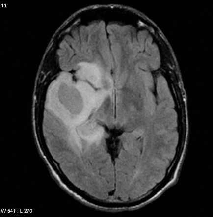 Oligoastrocytoma NOS (anaplastic) | Radiology Case | Radiopaedia.org