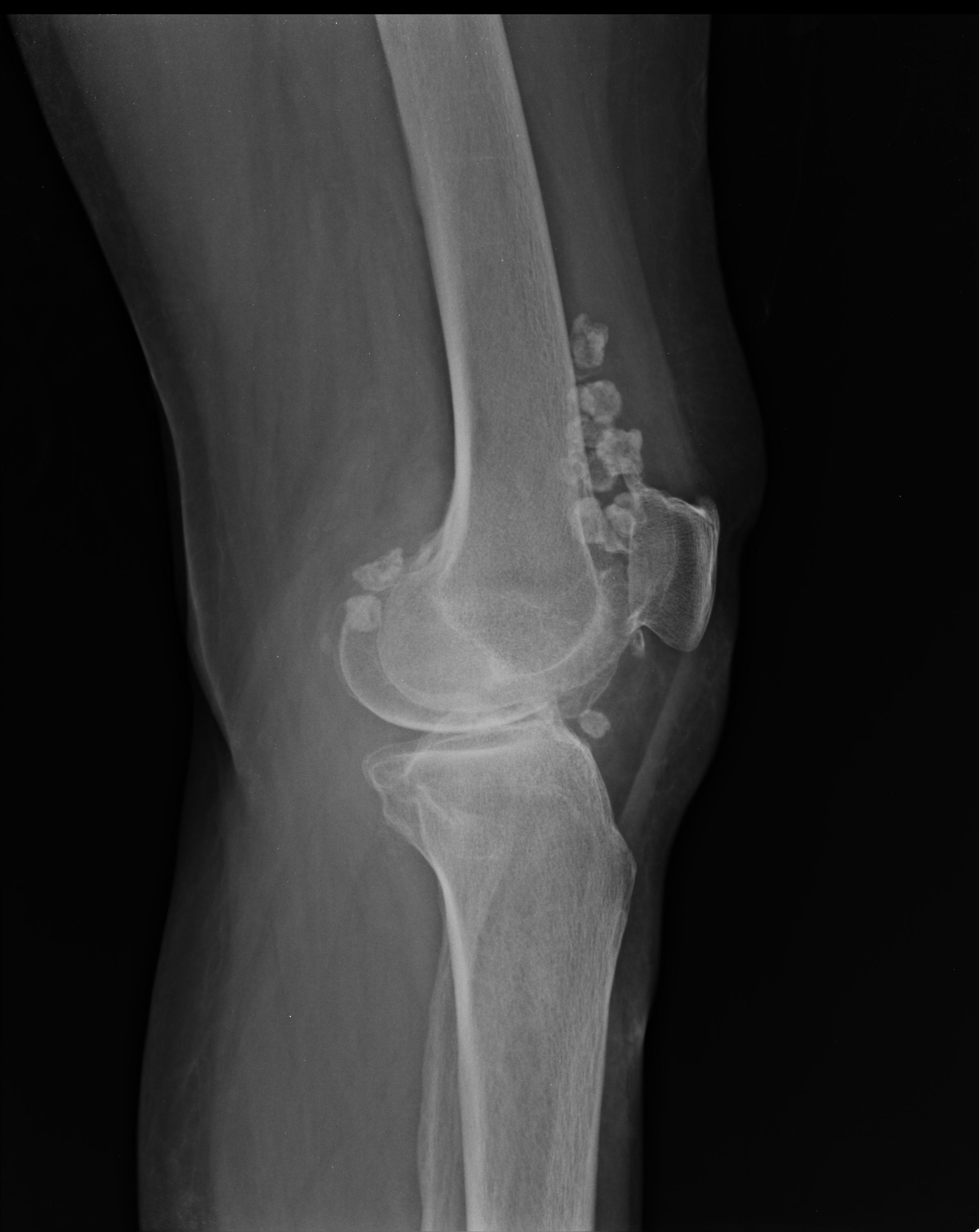 Synovial chondromatosis of the knee | Image | Radiopaedia.org