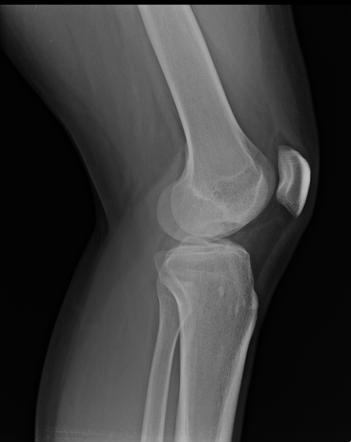 Osteochondral defect | Radiology Reference Article | Radiopaedia.org