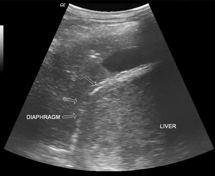 Hepatic abscess | Radiology Reference Article | Radiopaedia.org