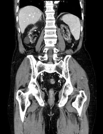 case study of cystic kidney disease