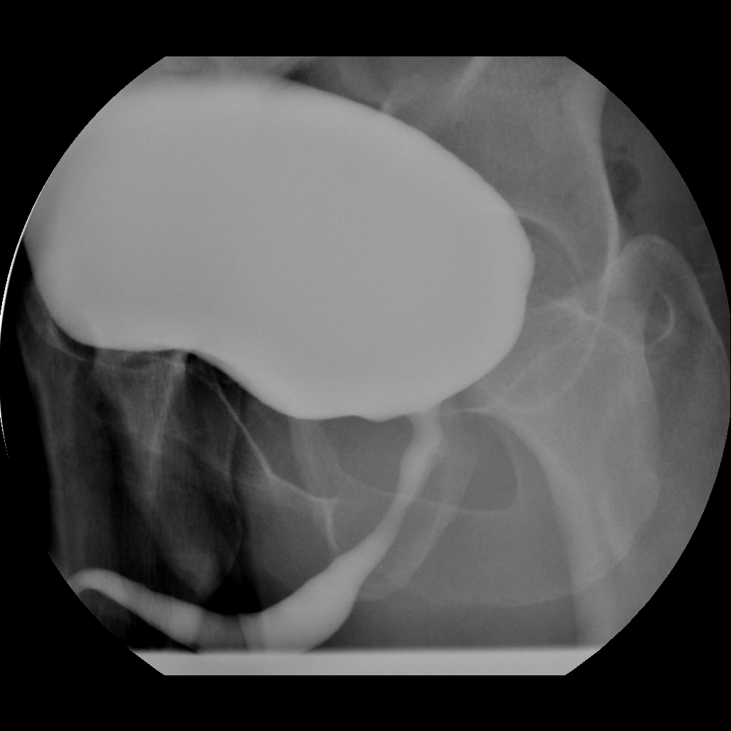 Normal Retrograde Urethrogram Rug And Voiding Cystourethrogram Vcug