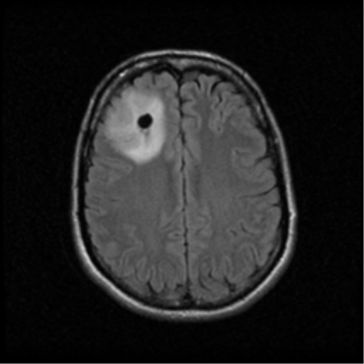 Oligodendroglioma NOS | Image | Radiopaedia.org