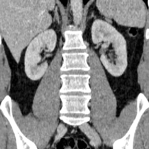 Adrenal glands (normal CT anatomy) | Image | Radiopaedia.org