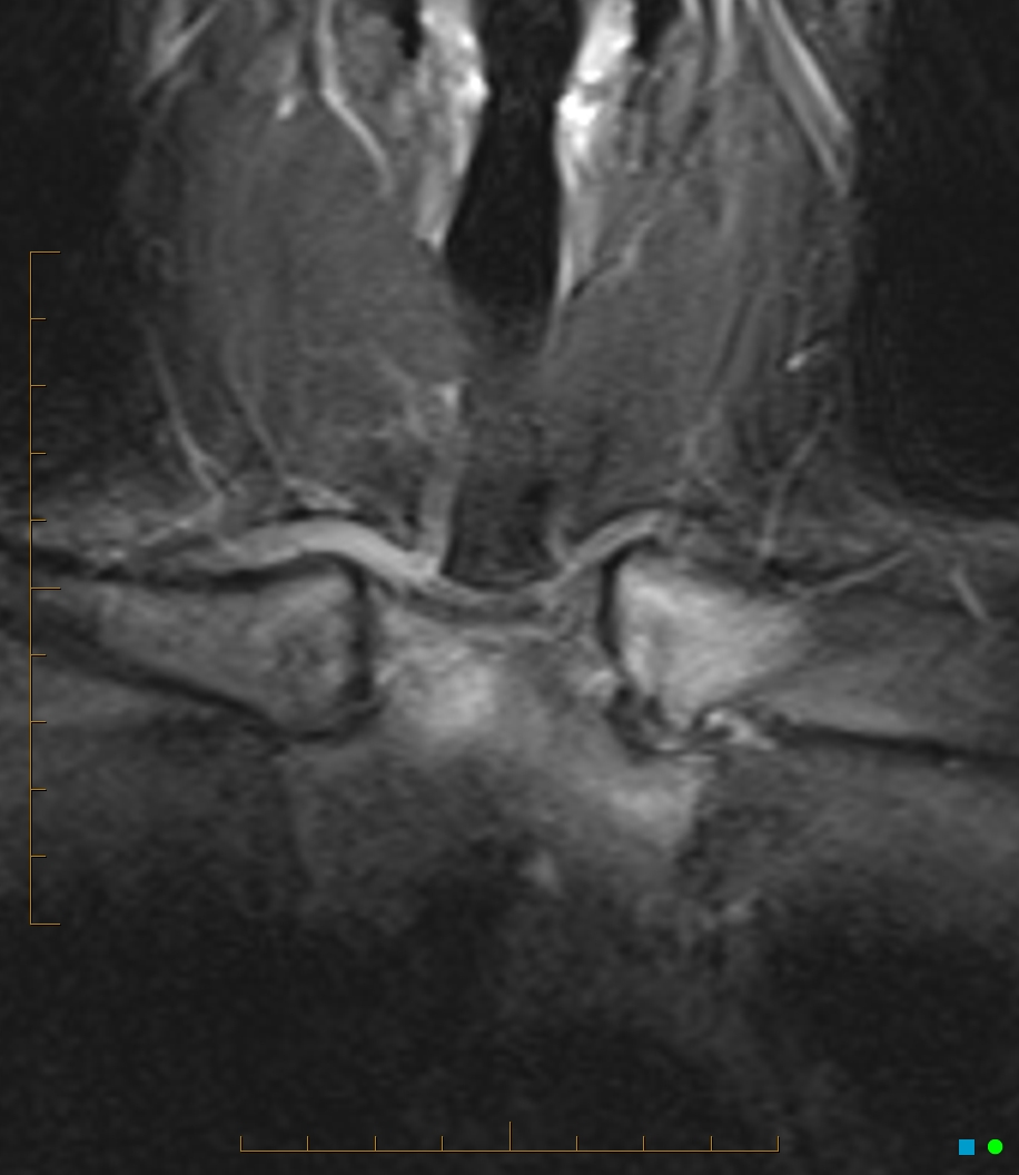 Inflammatory arthritis | Image | Radiopaedia.org