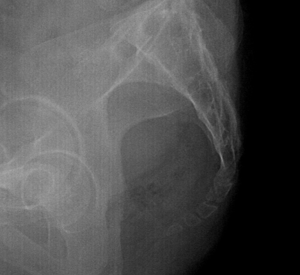 Coccyx fracture | Image | Radiopaedia.org