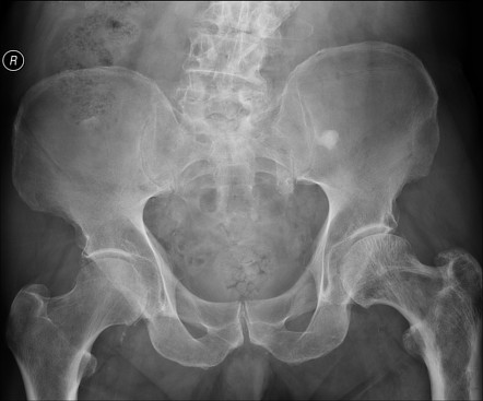 Paget Disease Of The Femur Radiology Case Radiopaedia Org