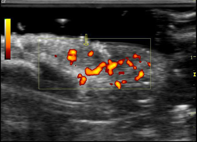 Glomus Tumour | SpringerLink