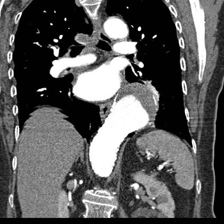 Thoracic Aortic Aneurysm Radiology Case Radiopaedia Org