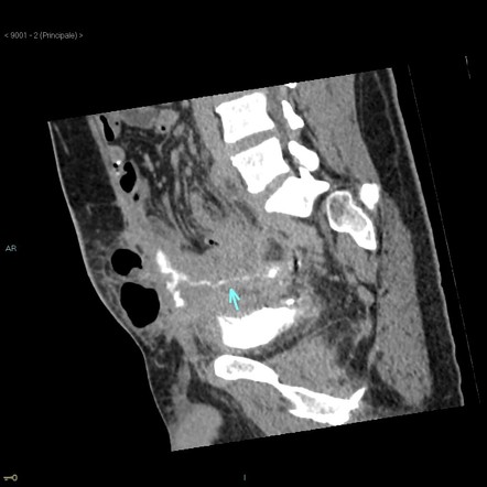 Colocutaneous fistula | Radiology Case | Radiopaedia.org