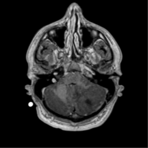 Medulloblastoma 