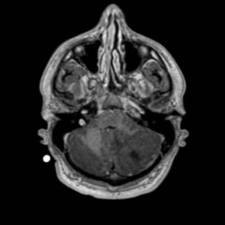 Medulloblastoma | Image | Radiopaedia.org