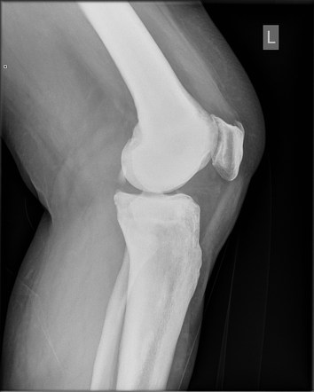 Viewing playlist: Osteosclerosis dd | Radiopaedia.org