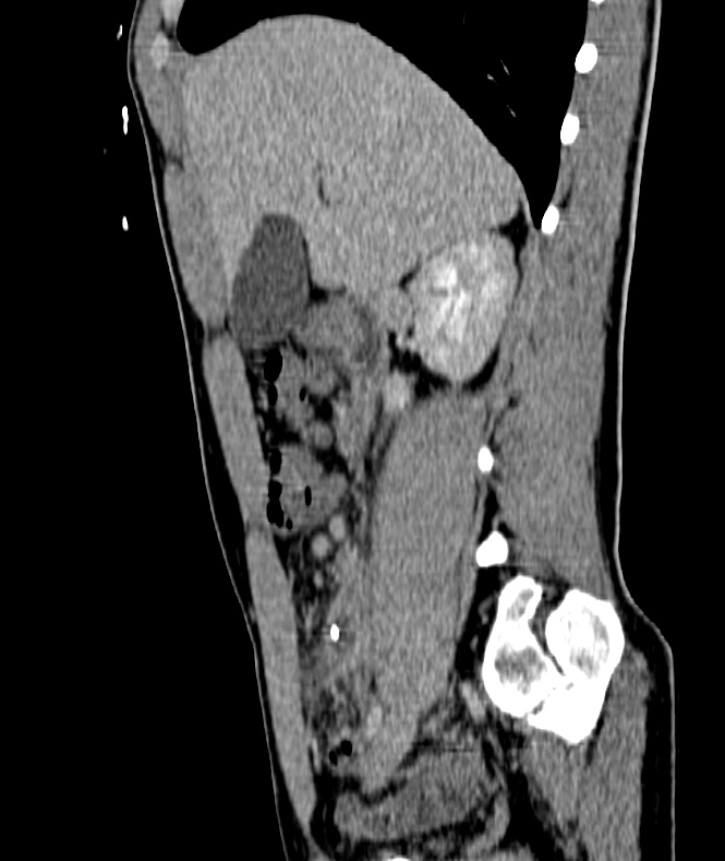 Intra Abdominal Abscess After Appendectomy Image