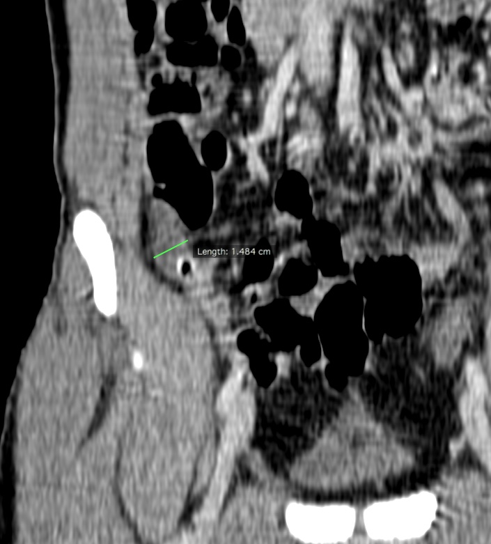 Intra Abdominal Abscess After Appendectomy Image