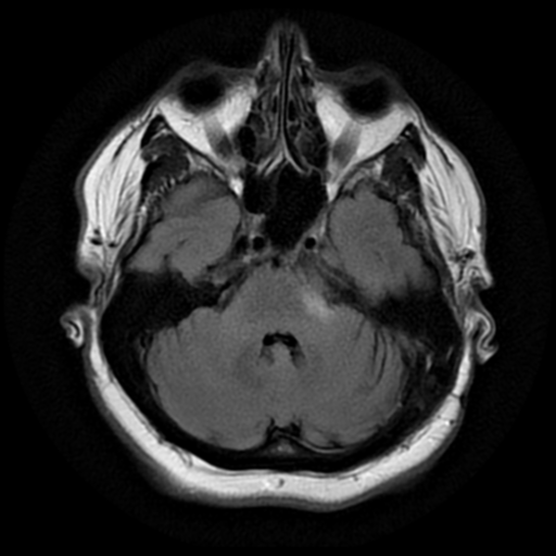 Recurrent cerebellopontine angle meningioma | Image | Radiopaedia.org