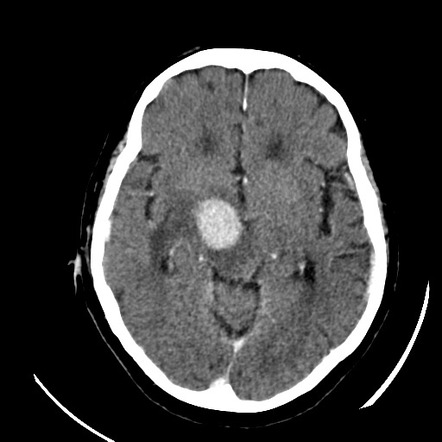 Primary CNS lymphoma | Radiology Case | Radiopaedia.org