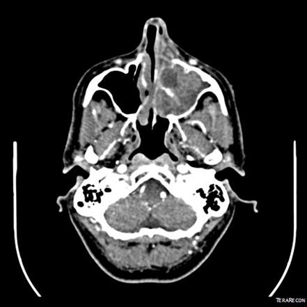 adenoid cystic carcinoma mri)