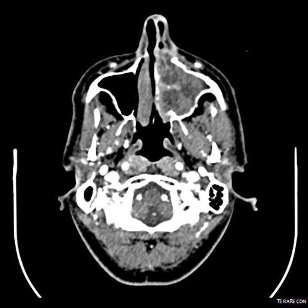 nasal sinus cyst