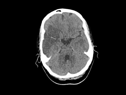 Right MCA territory infarct | Radiology Case | Radiopaedia.org